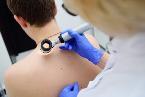 excizie alunite dermatoscopie